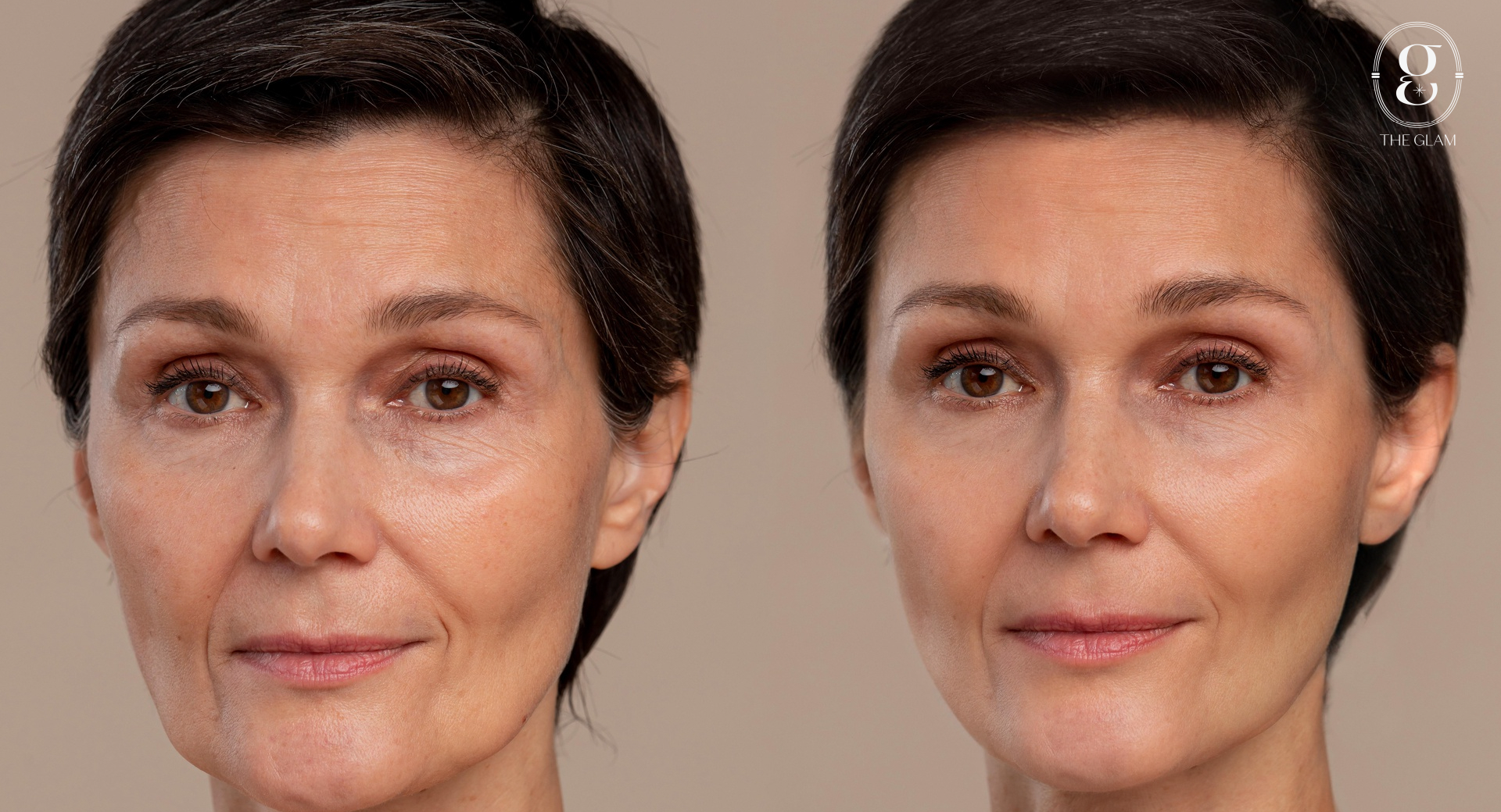 How long does Morpheus8 last? How often should it be done to see results?
